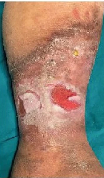 Clinical documentation for venous ulcer with compression and Polyhexanide + Poloxamer