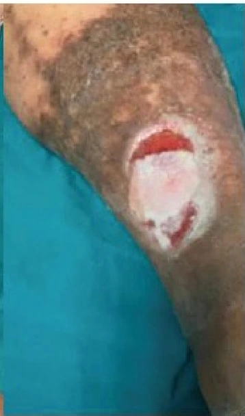 Venous ulcer clinical photograph 2
