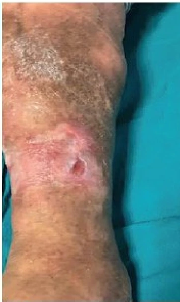 Venous ulcer clinical photograph 3