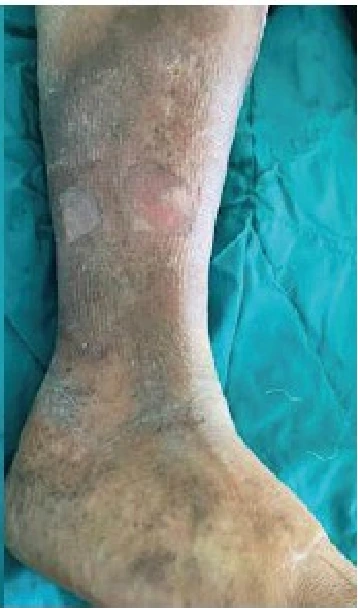 Venous ulcer clinical photograph 4