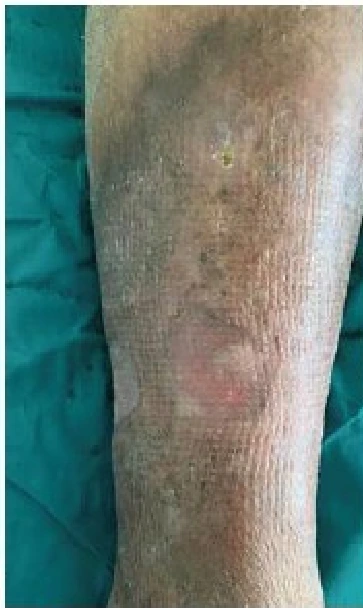 Venous ulcer clinical photograph 5