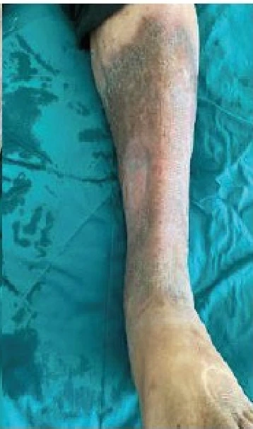 Venous ulcer clinical photograph 6