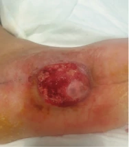 Clinical documentation for diabetic foot postoperative wound with PRF