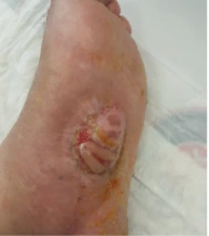 Diabetic foot postoperative wound clinical photograph dated 11.07.2022