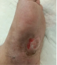 Diabetic foot postoperative wound clinical photograph dated 17.07.2022