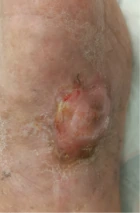Diabetic foot postoperative wound clinical photograph dated 21.07.2022
