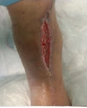 Clinical documentation for diabetic incisional wound after surgery