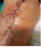 Diabetic incisional wound clinical photograph 2