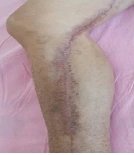 Diabetic incisional wound clinical photograph 3