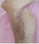 Diabetic incisional wound clinical photograph 4