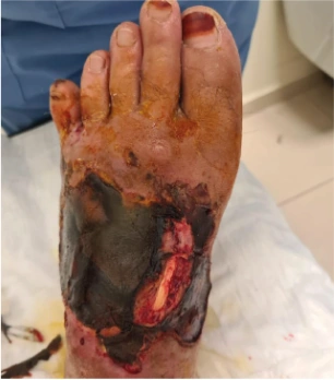 Clinical documentation for traumatic diabetic wound with NPWT and Polyhexanide + Poloxamer