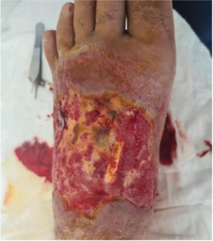 Traumatic diabetic wound clinical photograph dated 12.06.2022