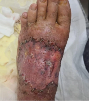 Traumatic diabetic wound clinical photograph dated 26.06.2022