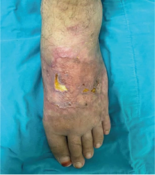 Traumatic diabetic wound clinical photograph dated 07.10.2022