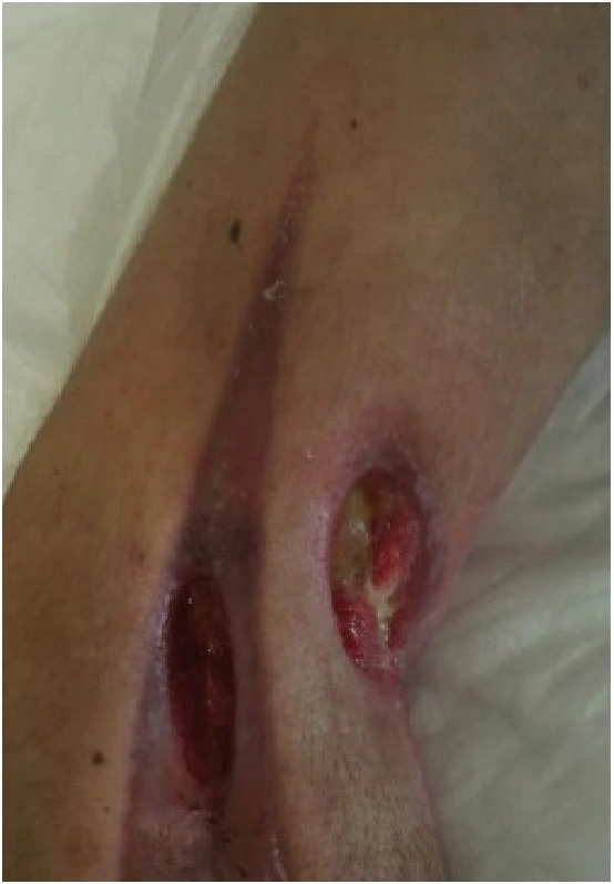 Clinical documentation for electrical injury with Polyhexanide + Poloxamer