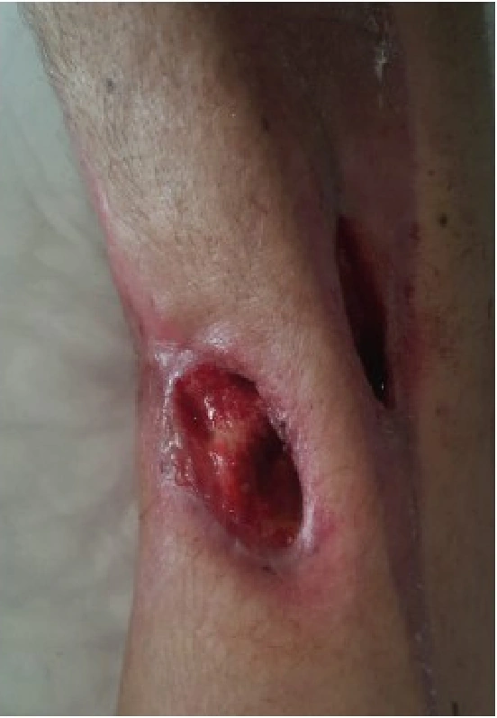 Electrical injury clinical photograph dated 06.04.2022