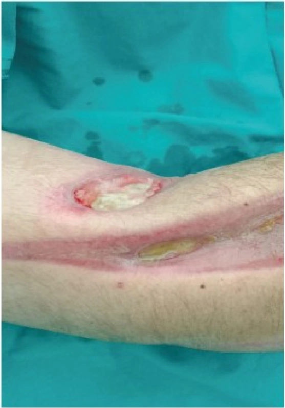 Electrical injury clinical photograph dated 11.04.2022