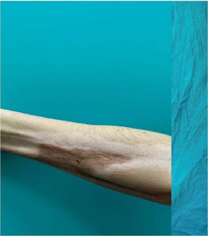 Electrical injury clinical photograph dated 22.04.2022