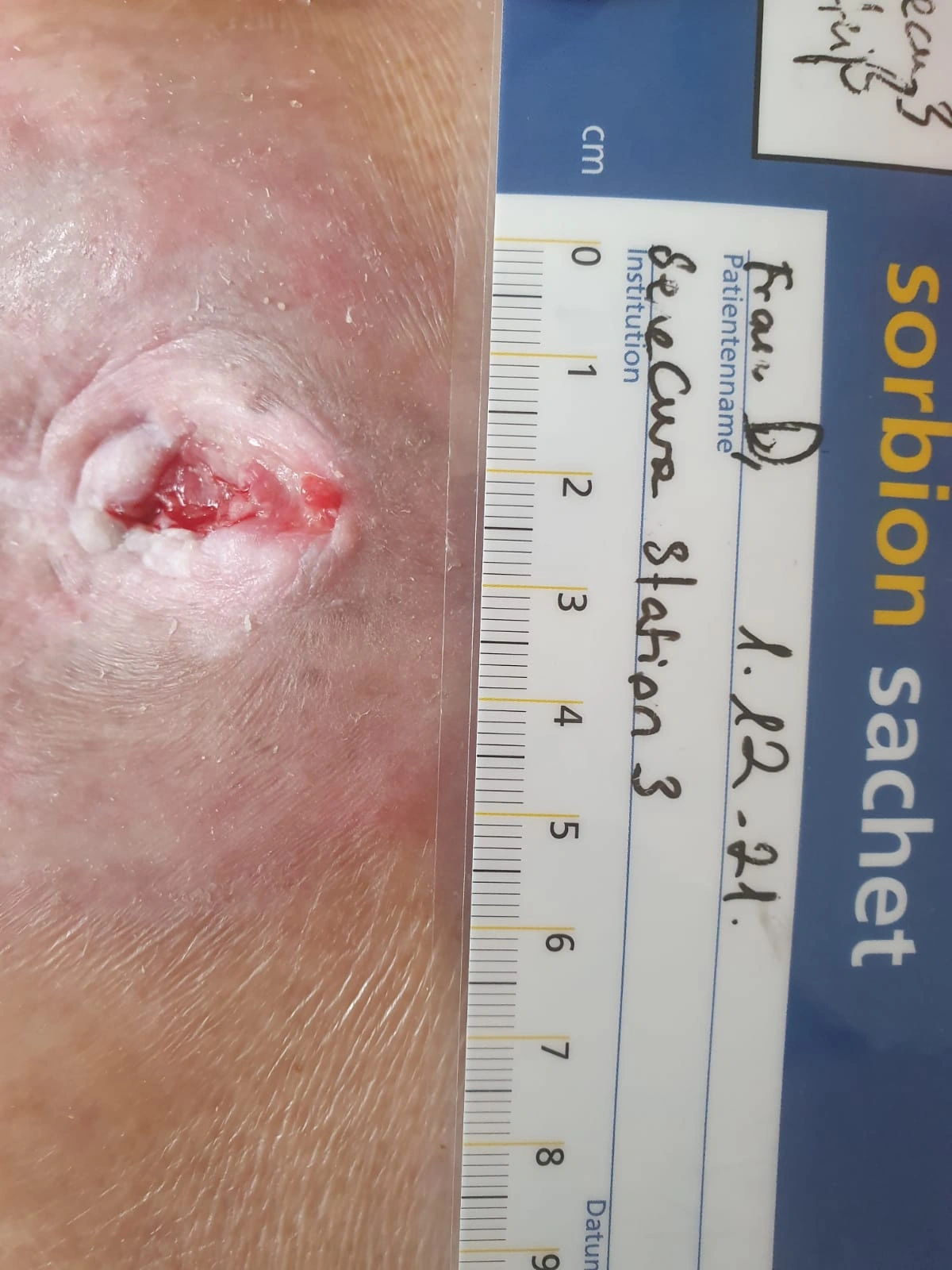 Clinical documentation for pressure ulcer wound care