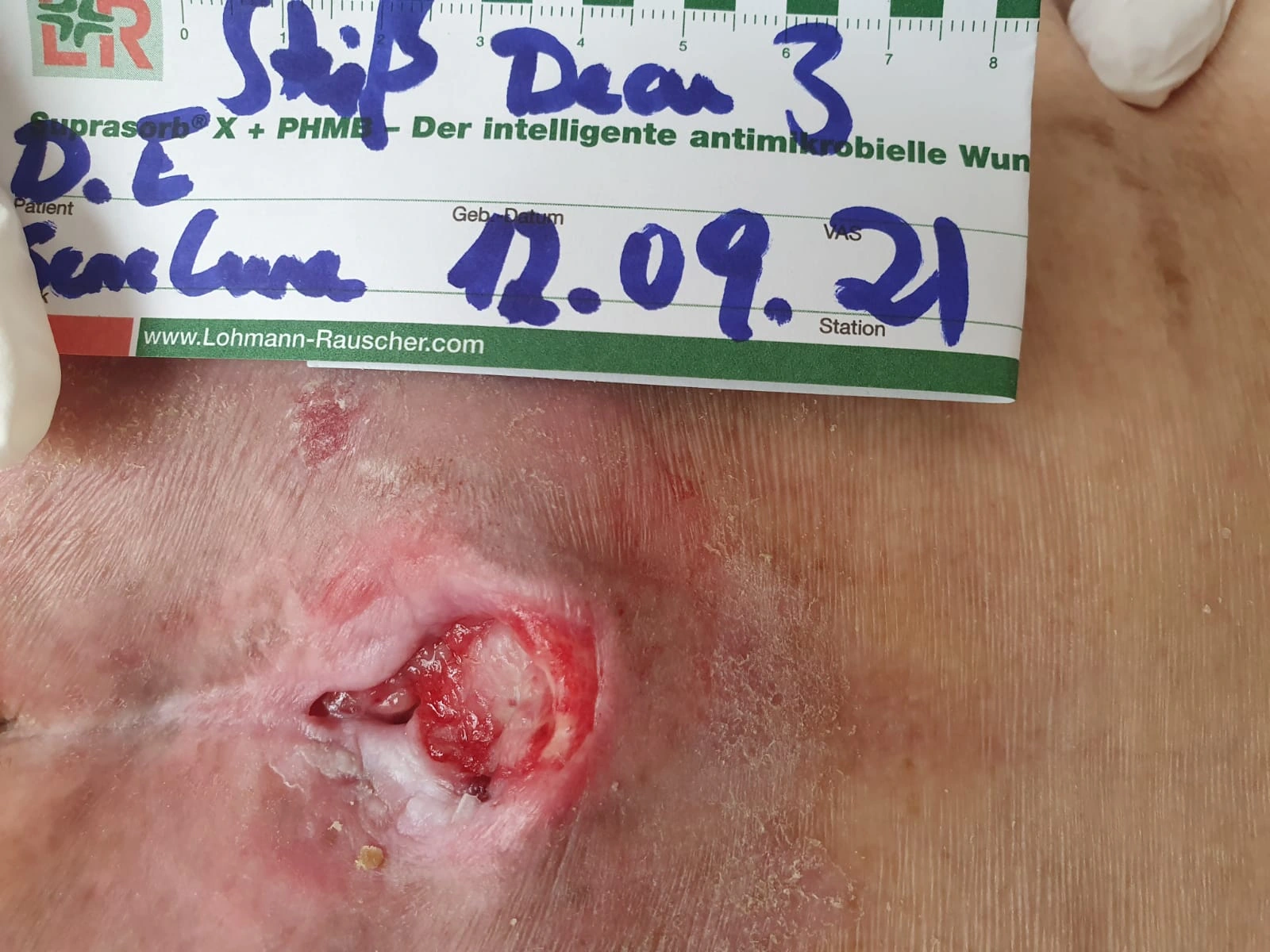 Pressure ulcer clinical photograph 2