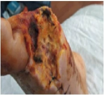 Clinical documentation for diabetic foot wound care