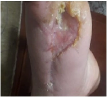 Diabetic foot wound clinical photograph 2