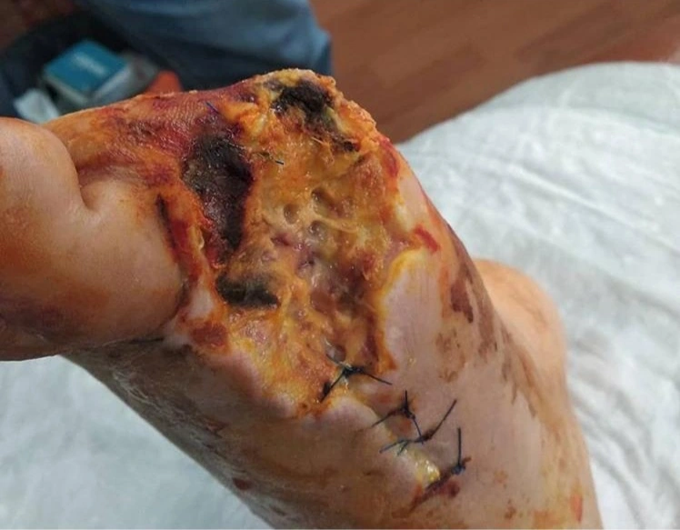 Diabetic foot wound clinical photograph 4