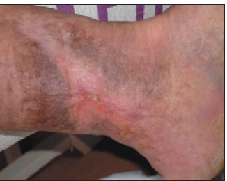 Clinical documentation for venous ulcer Actolind experience