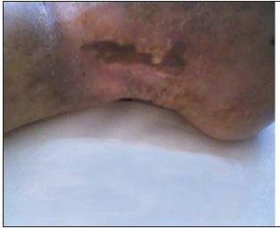 Venous ulcer follow-up after 82 days