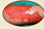 Clinical documentation for chronic wound case