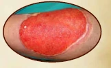 Ten-year chronic wound pre-graft appearance 2