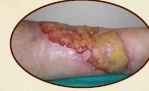 Ten-year chronic wound care progress 1