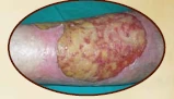 Ten-year chronic wound care progress 2