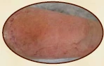 Ten-year chronic wound post-graft appearance 1