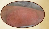 Ten-year chronic wound post-graft appearance 2