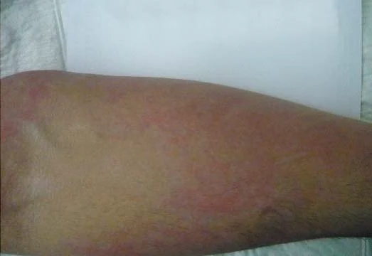 Second-degree burn follow-up after 10 days