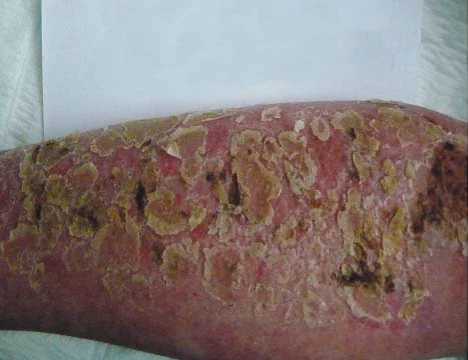 Second-degree burn initial wound appearance