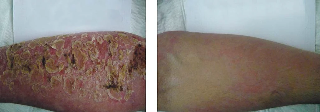 Clinical documentation for burn care Actolind experience