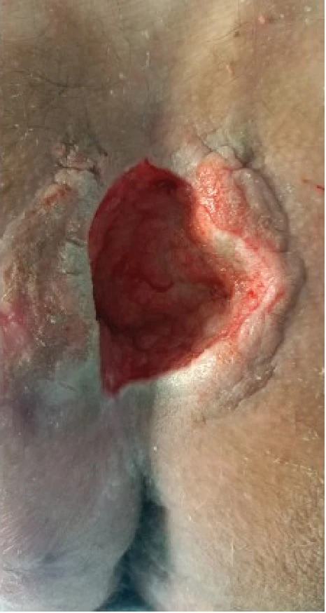 Cavity wound clinical photograph dated 26.02.2022
