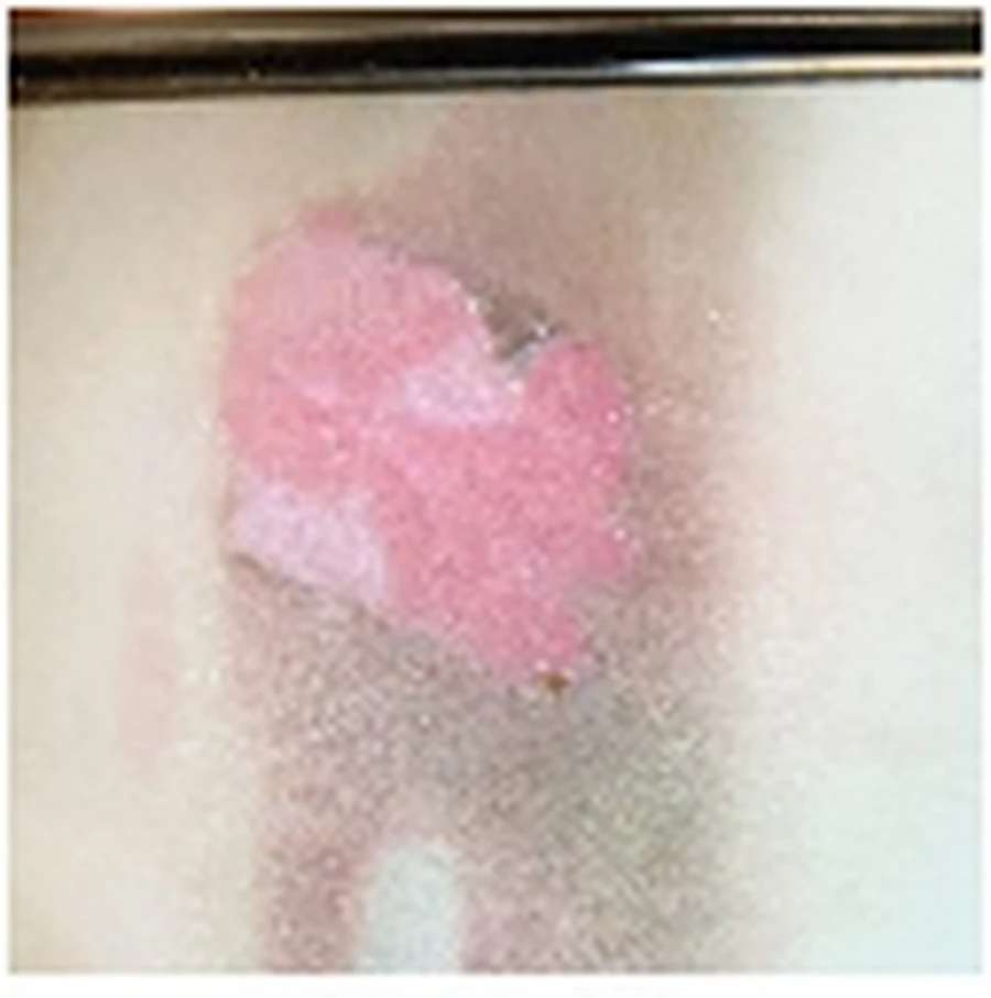 Case 2 second-degree dermal burn clinical photograph 1