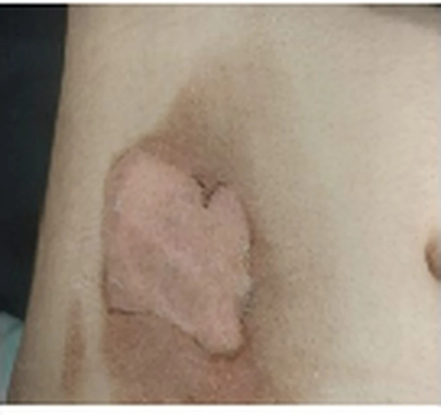 Case 2 second-degree dermal burn clinical photograph 2