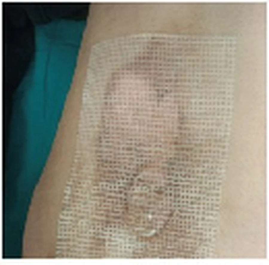 Case 2 second-degree dermal burn clinical photograph 3