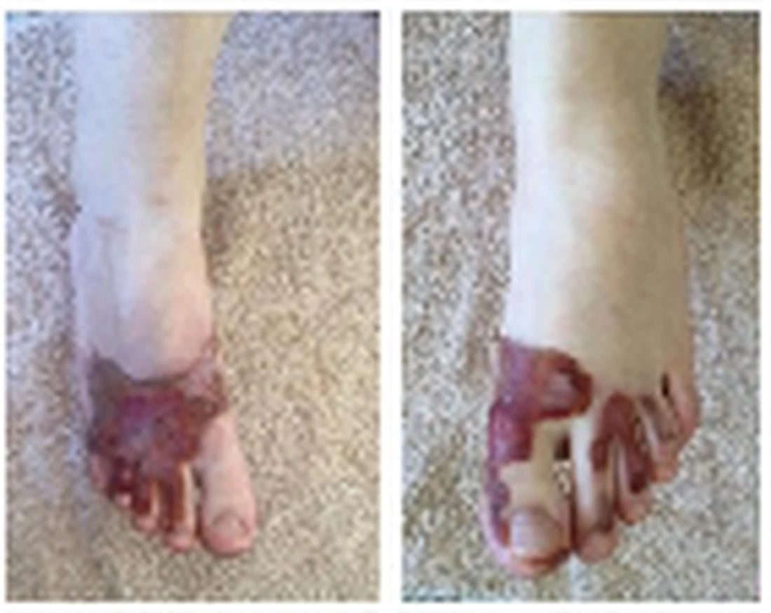 Case 3 bilateral foot burn clinical image series B