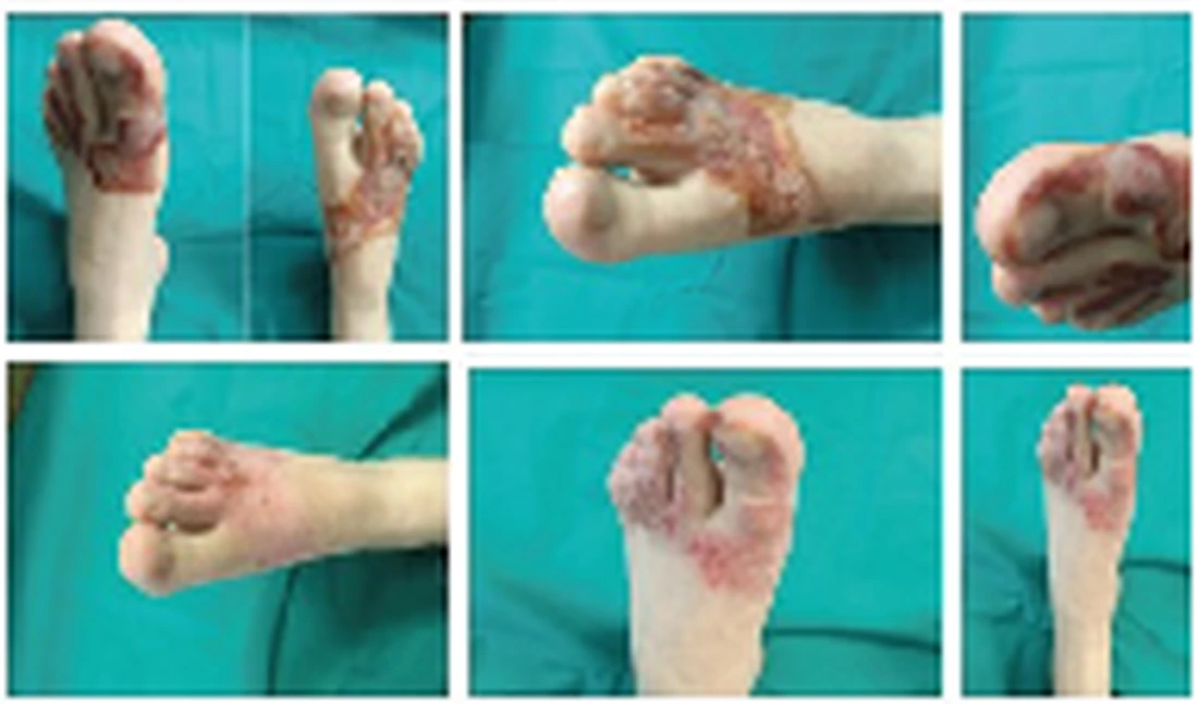 Case 3 bilateral foot burn clinical image series C
